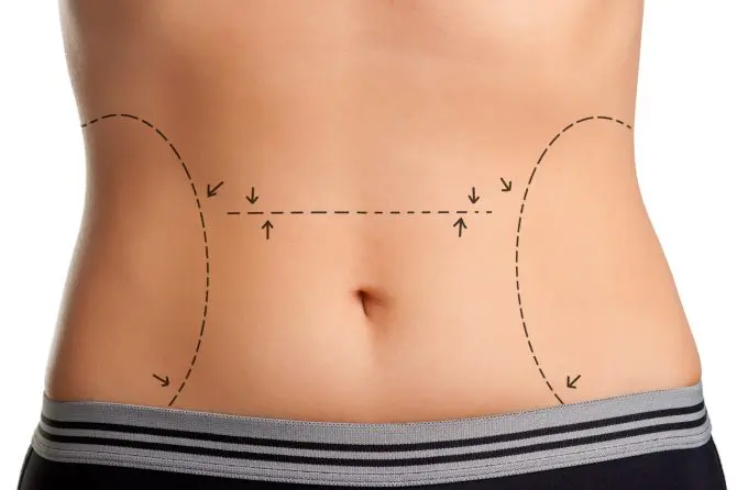 belly with tummy tuck lines