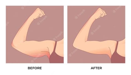 Arm Lift Surgery - Transform Your Arms and Boost Confidence!