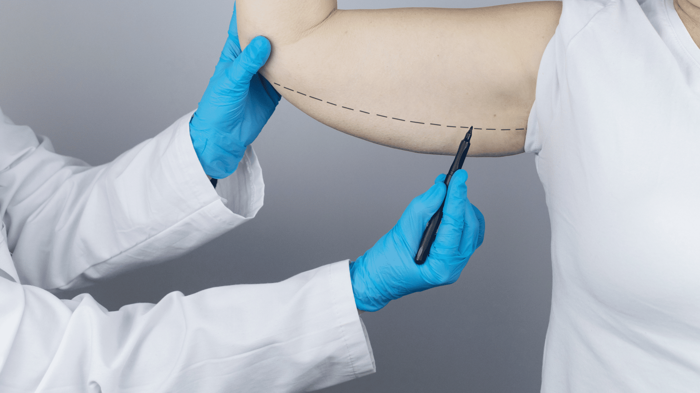Doctor Holds the Hand of a Female Patient on a White Background. the Concept of Skin Tightening on the Hand and Fat Removal, Plastic Surgery, Markers, Copy Space, Brachioplasty