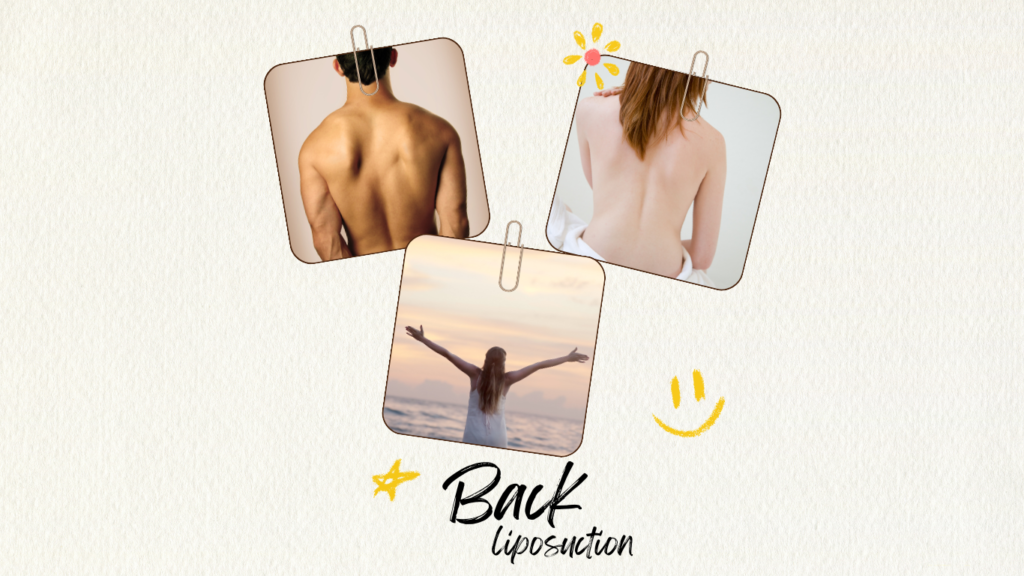 A collage of three images related to back liposuction. The top left image shows the bare back of a man, highlighting a smooth and toned appearance. The top right image features the bare back of a woman, also showcasing a smooth, contoured back. The bottom image displays a woman standing at the beach during sunset, with her arms raised in a gesture of freedom, symbolizing confidence and satisfaction. The words "Back Liposuction" are written below the images, surrounded by playful doodles of a smiley face, star, and sun.